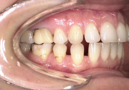 Quando un Trattamento Ortodontico Diventa Oggetto di Contenzioso Legale